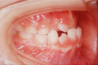 矯正歯科治療の対応症例