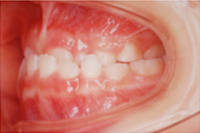 矯正歯科治療の対応症例