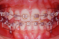 矯正歯科治療の対応症例