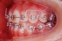 矯正歯科治療の対応症例