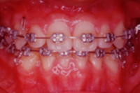 矯正歯科治療の対応症例