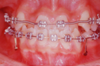 矯正歯科治療の対応症例