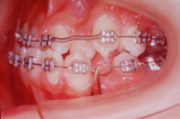 矯正歯科治療の対応症例