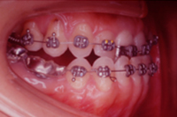 矯正歯科治療の対応症例