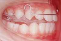 矯正歯科治療の対応症例