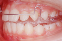 矯正歯科治療の対応症例