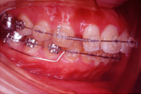 矯正歯科治療の対応症例