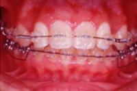 矯正歯科治療の対応症例