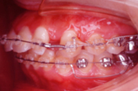 矯正歯科治療の対応症例