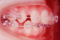 矯正歯科治療の対応症例