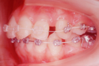 矯正歯科治療の対応症例