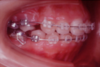 矯正歯科治療の対応症例