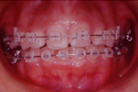 矯正歯科治療の対応症例