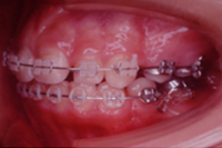 矯正歯科治療の対応症例