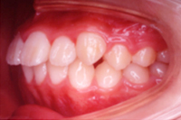 矯正歯科治療の対応症例