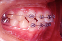 矯正歯科治療の対応症例