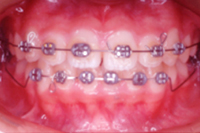 矯正歯科治療の対応症例