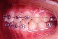 矯正歯科治療の対応症例