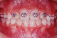 矯正歯科治療の対応症例
