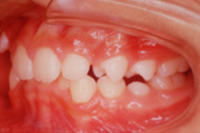 矯正歯科治療の対応症例