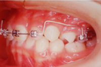 矯正歯科治療の対応症例