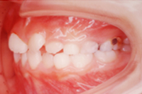 矯正歯科治療の対応症例