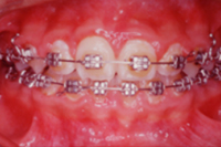 矯正歯科治療の対応症例