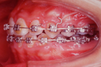 矯正歯科治療の対応症例