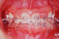 矯正歯科治療の対応症例