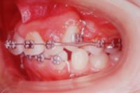 矯正歯科治療の対応症例