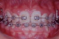 矯正歯科治療の対応症例