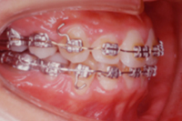 矯正歯科治療の対応症例