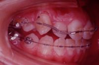 矯正歯科治療の対応症例