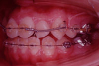 矯正歯科治療の対応症例
