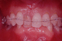 矯正歯科治療の対応症例