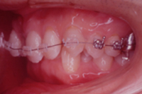 矯正歯科治療の対応症例