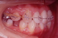 矯正歯科治療の対応症例
