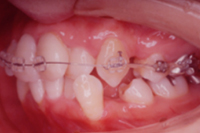 矯正歯科治療の対応症例