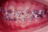 矯正歯科治療の対応症例