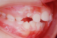 矯正歯科治療の対応症例