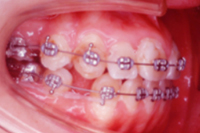 矯正歯科治療の対応症例