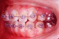 矯正歯科治療の対応症例