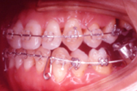 矯正歯科治療の対応症例