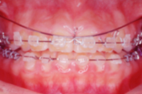 矯正歯科治療の対応症例