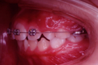 矯正歯科治療の対応症例