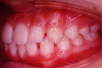 矯正歯科治療の対応症例