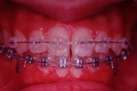 矯正歯科治療の対応症例