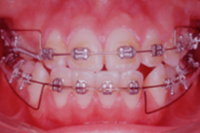 矯正歯科治療の対応症例