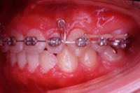 矯正歯科治療の対応症例