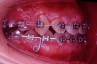 矯正歯科治療の対応症例